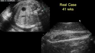 Mistakes to Avoid in the 2nd and 3rd Trimesters Fetal Anatomy and Measurement