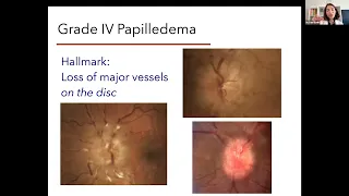 Modified Frisen Papilledema Grading Scale with Neuro Ophthalmologist Rani Banik, MD