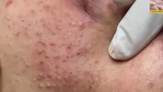 blackheads removal youtube 2019