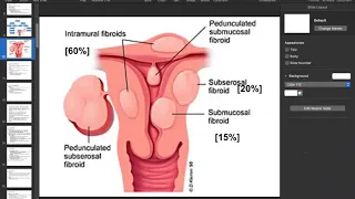 Uterine Fibroids by Prof. Dr Farida Wagan ( Gynae & Obst: ) on held 4th June 2020