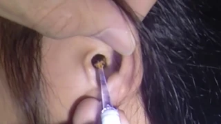 Top 3 Girl's Massive Impacted Earwax Removal