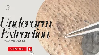 Underarm Extraction! - After Laser hair removal