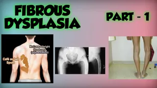 FIBROUS DYSPLASIA - Fibroosseous lesions ( part - 1 )