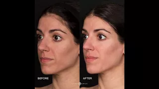 DERMATOLOGIST Acne Scar Treatment | RevePeel TCA PHENOL Before AND After RESULTS | DR JASON EMER