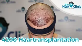 Haartransplantation Türkei - Haarausfall Erfahrung
