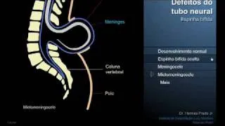 Espinha bífida - Defeitos do tubo neural - mielomeningocele