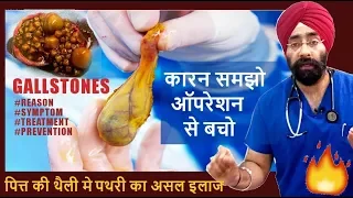 Rx GALLSTONE #1 (Hindi) पित्त की थैली मे पथरी का कारन समझो ऑपरेशन से बचो Dr.Education + Bloopers