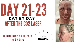 CO2 laser - post procedure WHAT TO EXPECT- day by day -21-23