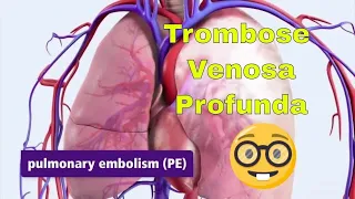 Trombose Venosa Profunda (TVP) e Embolia Pulmonar (EP).