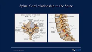 Multiple Sclerosis and the Spinal Cord