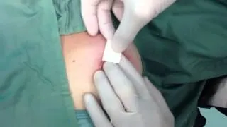 An Alternative Technique for Steri-Strip Application