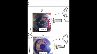 How to identify a Shallow Anterior Chamber with just a Torchlight? #Mustknow #Shorts