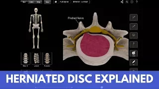 What is a Lumbar Herniated Disc? How to Treat It Without Surgery (ANIMATED VIDEO).