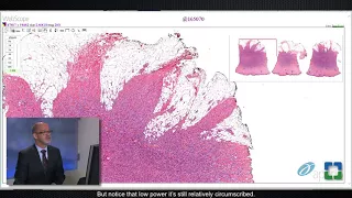 Pathology Insights: Challenging Cutaneous Spindle Cell Tumors with Steven Billings, MD