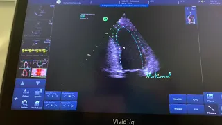 How to measure strain on the GE Vivid echo machines