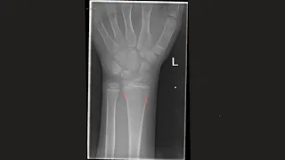 Common paediatric fracture patterns on x-ray