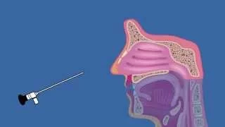 What is Nasal Endoscopy?