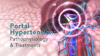 PORTAL HYPERTENSION: Pathophysiology and Common Treatments