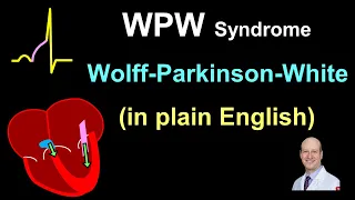 WPW: Explanation and Treatment - in Plain English!