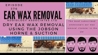 DRY EAR WAX REMOVAL USING JOBSON HORNE AND SUCTION   EP 376