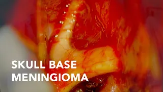 Surgery for Cavernous Sinus/Sphenoid Wing Meningioma