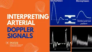 Interpreting Arterial Doppler Signals
