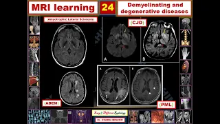 MRI learning 24 Demyelination and degenerative diseases