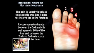 Interdigital Neuroma Morton's Neuroma - Everything You Need To Know - Dr. Nabil Ebraheim