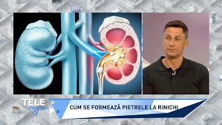 Ce formează pietrele la rinichi, ce dureri provoacă şi cum pot fi eliminate