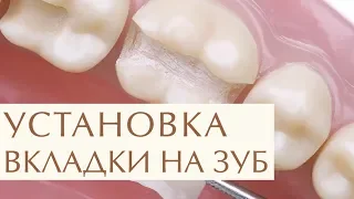 ✨  Плюсы восстановления зуба с помощью керамической вкладки. Керамическая вкладка на зуб. 12+