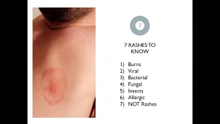 5 Rashes that Kill & 7 Most Common in ED