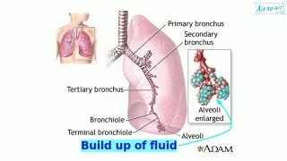 cardiac asthma