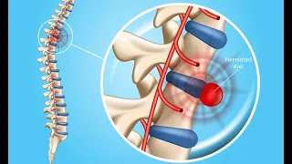 CÙNG BẠN SỐNG KHỎE (28/12): PHƯƠNG PHÁP ĐIỀU TRỊ THOÁT VỊ ĐĨA ĐỆM