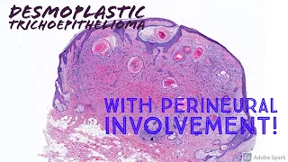 Desmoplastic Trichoepithelioma (with perineural involvement!)