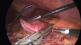 Laparoscopic Mini gastric bypass OAGB / MGB