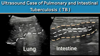 A Rare Case of Active Pulmonary and Intestinal Tuberculosis  (TB )  in One Patient | Ultrasound