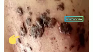 Healed herpes zoster infection rash medical video