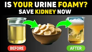 Beware ! These 11 Foods Could Worsen Your Proteinuria and Kidney Disease