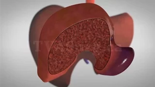 Segment I/IV mesoheptectomy