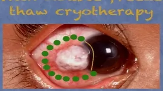 AIOC2018 - IC423 - Topic - Ocular surface squamous neoplasia: Diagnosis and management