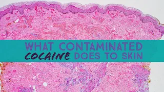 What contaminated cocaine does to skin (Levamisole Vasculopathy) dermpath dermatology pathology