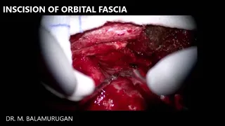 Excision of Orbital hemangioma