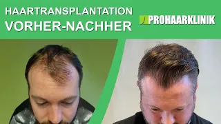 Haartransplantation vorher nachher: Christoph - PROHAARKLINIK