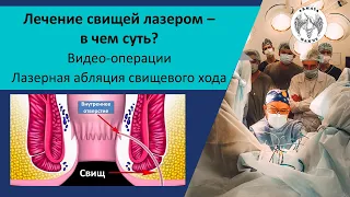 Лазерное лечение свищей - в чем суть? Видео операции