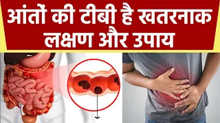 आंतों की टीबी होना है बेहद खतरनाक,इन Symptoms को न करें Ignore । Intestinal Tuberculosis । Boldsky