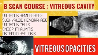 B scan course || learn how to  B scan vitreous opacities