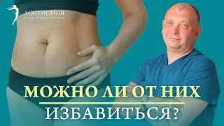 Как избавиться от растяжек на животе? Методы борьбы с растяжками: от кремов до медицинских процедур