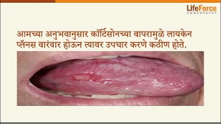 What should you know about Lichen Planus treatment Marathi- Part 2/2
