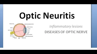 Ophthalmology Optic neuritis Papillitis NeuroRetinitis RetroBulbar phosphenes uhthoff pulfrich