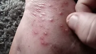 DONT DO THIS!!!  I  POPPED THE ANT BITES AND PEROIXDED MY FEET DOWN